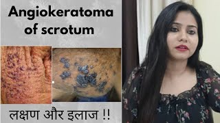 Angiokeratoma of fordyceScrotum homeopathic treatment  Angiokeratoma symptomscauses amp medicine [upl. by Erin]