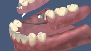 Протезирование Бюгельный нижний протез с замковой фиксацией [upl. by Woodrow585]