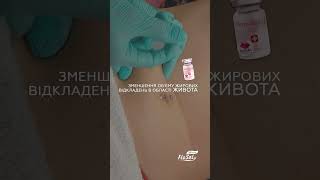 Корекція локальних жирових відкладень в ділянці живота Dermaheal LL мезотерапія [upl. by Secrest742]