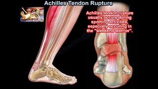 Achilles Tendon Rupture  Everything You Need To Know  Dr Nabil Ebraheim [upl. by Sanders300]