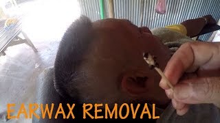 Ear wax removal  How to remove earwax easy on ear [upl. by Donegan]