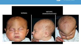 Neurosurgery Medical Student Primer  Craniosynostosis [upl. by Aliber]