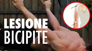 LESIONE DEL BICIPITE BRACHIALE CALISTHENICS [upl. by Arodoet658]