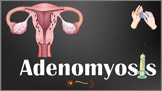 Adenomyosis  Definition Causes Risk Factors Signs amp Symptoms Diagnosis amp Treatment [upl. by Eirrotal63]