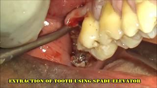 Severely infected upper right 3rd molar extraction [upl. by Janet]