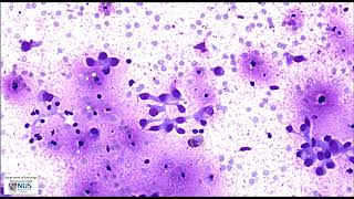 Cytology Thyroid nodule FNA  Metastatic breast carcinoma [upl. by Adorne]