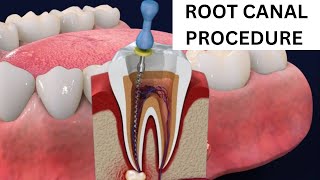 Root Canal Procedure Step by Step [upl. by Aicylla39]