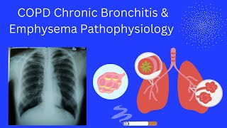 COPD Chronic Bronchitis amp Emphysema Pathophysiology [upl. by Gernhard982]