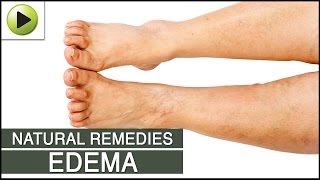 Edema  Natural Ayurvedic Home Remedies [upl. by Ardy]