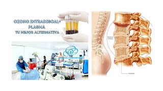 Discolisis con Ozono y PRP Lumbar Cervical en un tiempo [upl. by Ahsekal]