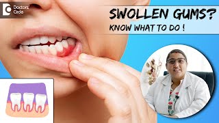 What Swollen Gums are telling you Know its Home Remedies DrKarthika Krishna KumarDoctors Circle [upl. by Godspeed370]