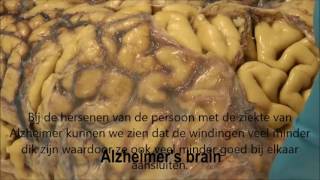 Dissectie hersenen normaal en Alzheimer [upl. by Crescentia]