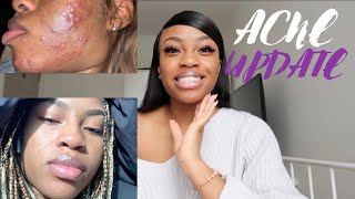 SKINCARE SATURDAYS  HOW I CLEARED 6 YEARS OF ACNE IN 3 MONTHS  FT MDacne [upl. by Odnesor]