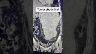 Tumor abdominal en tomografía [upl. by Isobel]