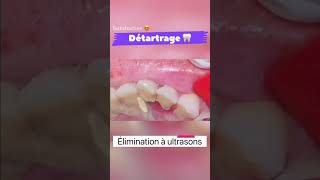 Détartrage dentaire à ultrasons 🦷shorts satisfying [upl. by Stafani]