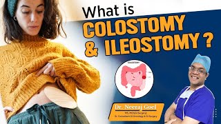 What is colostomy amp ileostomy  Stoma Bag Kya hai Dr Neeraj Goel [upl. by Yziar]