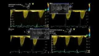 PSEUDO SEVERE AORTIC STENOSIS  STRESS ECHO [upl. by Nesto]