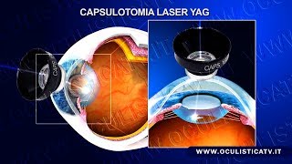 Cataratta secondaria capsulotomia laser YAG [upl. by Serrell]