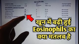 Eosinophils high in blood test means eosinophilia High Eosinophils cbc Blood test in hindi [upl. by Spencer]