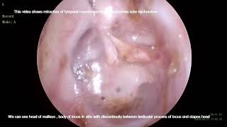 Grade IV Tympanic membrane retraction [upl. by Upshaw515]