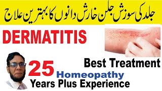 Dermatitis treatmentHomeopathySkin Itchingkhujli amp jild ki Kharish ka ilaj urdu [upl. by Aspia22]