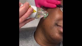 Treating Folliculitis and Hyperpigmentation With Laser Hair Reduction by the Lumenis Splendor X [upl. by Ragse]