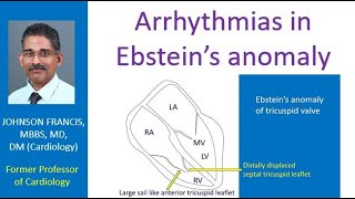 Arrhythmias in Ebstein’s anomaly [upl. by Sokcin]