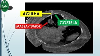 Biopsia de tórax guiada pela Tomografia Computadorizada conceitos básicos [upl. by Leahcar89]