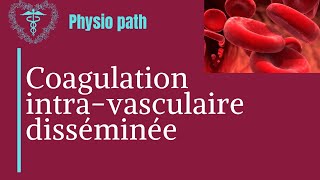 CIVD Coagulation intravasculaire disséminée [upl. by Astiram]