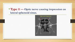 Classification of optic nerve in relation with Sphenoid Sinus [upl. by Meda470]