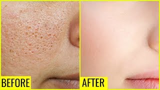 How to Get Rid of Large OPEN PORES Permanently  Anaysa [upl. by Nate]