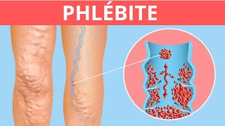 Phlébite  Symptômes Causes et Traitement [upl. by Nesnar970]