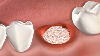 Ghép xương cấy răng implant  Implant bone graft [upl. by Fabiola]