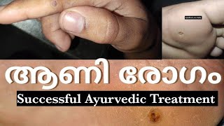 Foot Corn in Ayurveda footcorn cornremoval ayurveda Kadar [upl. by Saticilef]