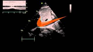 7 minutes IVC ultrasound part 1 [upl. by Gibson419]