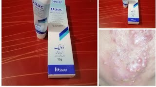 How to use Duac Gell for acne Best Gell for Acne remove Informative video for Acne treatment [upl. by Itra30]