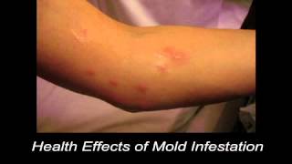 Health Effects of Mold Infestation [upl. by Deva221]