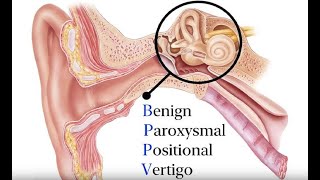 Benign Paroxysmal Positional Vertigo BPPV Symptoms and Causes  Diagnosis  Treatment  Prevention [upl. by Okajima973]