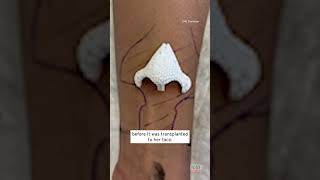 Woman Grows Nose on Her Arm shorts [upl. by Delia]