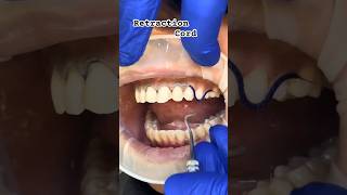 What is a Retraction Cord dental retractioncorddentistveneersrootcanalcrownfyptiktok [upl. by Shulman337]