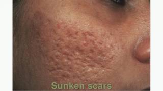 HOW TO GET RID OF ACNE SCARS [upl. by Nilyam]