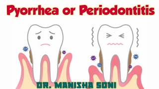 Pyorrhea  Periodontitis  Causes  Symptoms  Treatment [upl. by Lore]