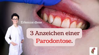 3 Anzeichen für Parodontose [upl. by Anniken]