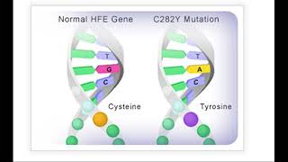 The Silent Killer Hereditary Hemochromatosis and Its Impact on Your Health [upl. by Conlin878]