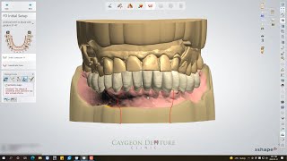 Immediate Lower Denture Digital Design [upl. by Reiner]