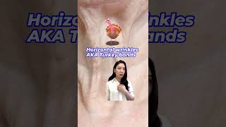 Neck wrinkles treatment thats US FDA approved neckwrinkles necklines neckbotox notox [upl. by Ecirtram945]