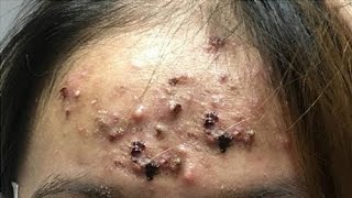 Big Cystic Acne Blackheads Extraction Blackheads amp Milia Whiteheads Removal Pimple Popping [upl. by Amaryl]