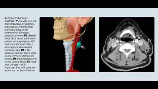 Branchial cystㅣthyroglossal cystㅣthornwaldt cyst radiology [upl. by Sivlek]