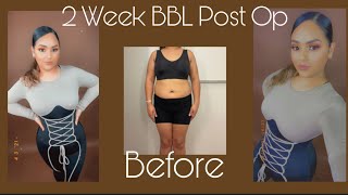 BBL 2 Week Post Op Update  Body Reveal  BBL Arm and Chin Lipo  305 plastic Surgery [upl. by Stan]