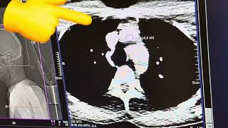 أشعة مقطعية للمخ بالصبغة CT brain angiography [upl. by Las]